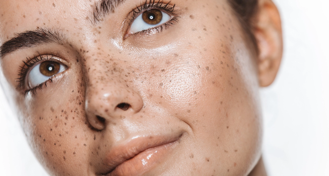 How freckles can change over time and what it means for your skin