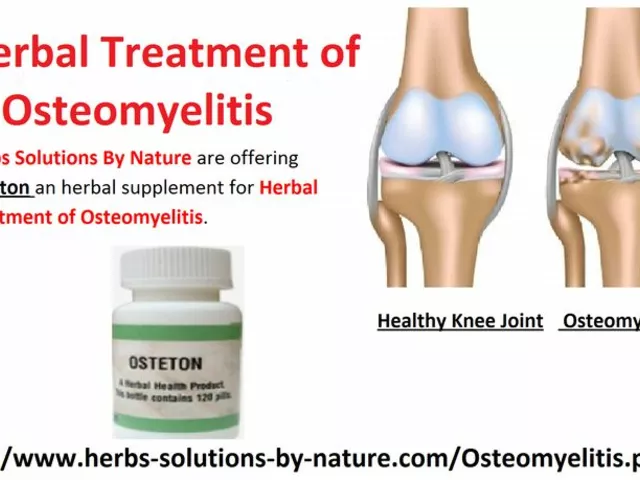 The Use of Voriconazole in the Treatment of Fungal Osteomyelitis